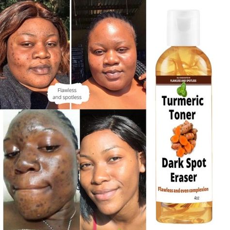 Fading Dark Spots On Face, How To Remove Dark Spots On Face, Discoloration On Face, Dark Spot Remover For Face, Dark Spot Remover, Cream For Dark Spots, Turmeric Face, Acne Dark Spots, Dark Spots On Face