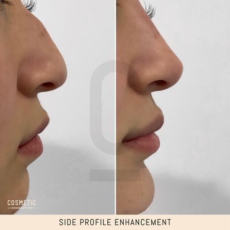 Have you ever wondered what your side profile could look like if it was more harmonised? Here’s a hint: it’s probably going to be amazing.⁠ ⁠ As pictured here - this patients nose, lips and chin were treated to create full harmonisation of the profile. Confidence looks good® Lip Fillers Side Profile, Lip Filler Side Profile, Lips Side Profile, Fashion Palette, Small Lips, Clear Healthy Skin, Romantic Partner, Body Posture, Dermal Fillers