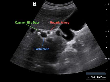 Abdominal (Quick Guide) – "The" Med Student Ultrasound eBook Ultrasound Anatomy, Abdomen Ultrasound, Abdominal Ultrasound, Diagnostic Medical Sonography Student, Ultrasound School, Liver Anatomy, Sonography Student, Medical Sonography, Ultrasound Sonography