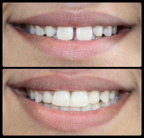 Great work by our principal dentist Onkar Dhanoya! This patient didn't like the gaps in their smile. Onkar put composite veneers in place to close the gaps & improve the shape of their teeth 😁 Would you like to transform your smile? Book a FREE consultation here: http://www.honourhealth.co.uk Smile Book, Composite Veneers, Before Baby, Your Smile, Free Consultation, The Shape, Gap, Health, Quick Saves