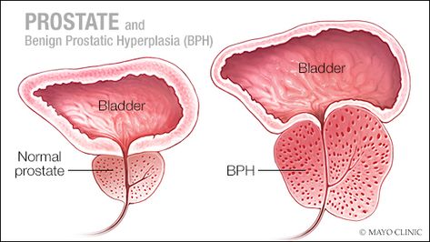 Benign prostatic hyperplasia, or BPH, is a common problem for older men. This condition also is known as an enlarged [...] Diet For Men, Prostate Surgery, Prostate Health Men, Diets For Men, Libido Boost, Creatinine Levels, Laser Therapy, Mayo Clinic, Natural Treatments