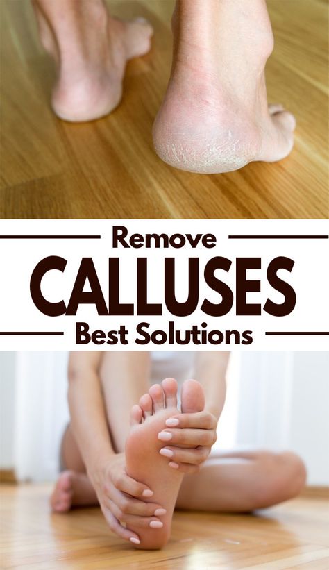 Feet Care Calluses, Best Callus Remover, Callous Remover, Electric Callus Remover, Foot Soak, Callus Removal, Interesting People, Simple Tricks, Skin Health