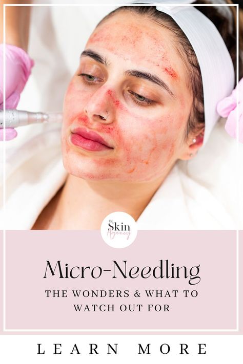 Unlock the Secret to Radiant Skin with Microneedling! Discover the amazing benefits of microneedling, from reducing wrinkles and acne scars to shrinking pores. Check out our before and after photos and learn what to expect with microneedling. Don't miss out on the opportunity to achieve flawless skin. Visit The Skin Agency today! Benefits Of Microneedling, Night Before Wedding, Laser Resurfacing, Age Gap, Shrink Pores, Skin Care Treatments, Girls Dpz, Flawless Skin, Skin Concern