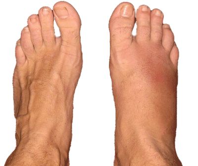 unilateral edema from stress fracture of forefoot Swelling Remedies, Hairline Fracture, Water Retention, Natural Health Remedies, Basketball Players, Health Remedies, Good Health, Football Players, Healthy Habits