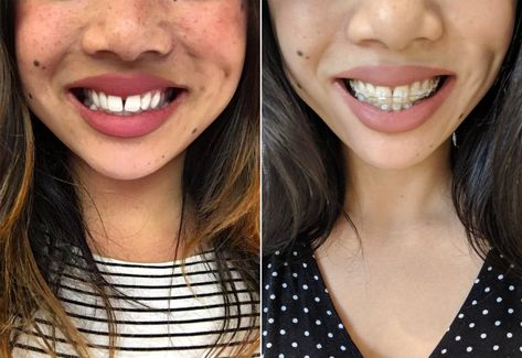 Should I Get Adult Braces? | POPSUGAR Beauty Clear Braces Ceramics, Braces Before And After, Braces Retainer, Ceramic Braces, Waterpik Water Flosser, Adult Braces, Getting Braces, Clear Braces, Brace Face