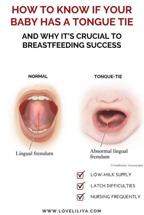 When a baby STRUGGLES to BREASTFEED, usually a TONGUE-TIE isn't the first thing that comes to mind. However, IT SHOULD!! Find out what a TONGUE-TIE is and how to DIAGNOSE it!! Failure To Thrive, Low Milk Supply, Tongue Health, Babies Newborn, Tongue Tie, Breastfed Baby, Lactation Consultant, Nursing Baby, Breastfeeding And Pumping