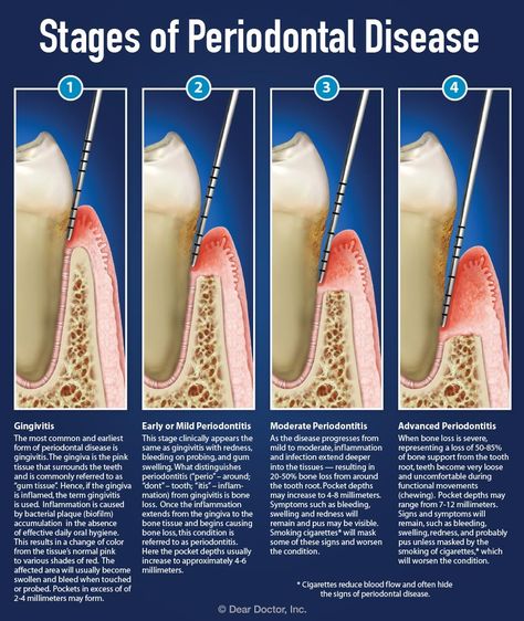 Understanding Periodontal Pockets Dental Hygienist School, Dental Assistant Study, Remedies For Tooth Ache, Dental Hygiene School, Dental Facts, Teeth Health, Bone Loss, Periodontal Disease, Dental Hygienist