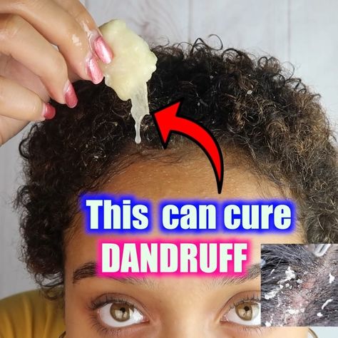 Struggling with persistent dandruff that REFUSES to go away but scared to use shampoos in a CG Friendly routine? Here are my personal tips! Natural Wavy Curly Hair, Severe Dandruff, Prevent Dandruff, Dandruff Solutions, Dandruff Remedy, Hair Dandruff, Baking Soda Shampoo, Natural Hair Community, Itchy Scalp