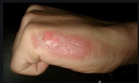 This is a minor burn on a hand. it is scabbing/peeling Remedies For Burns, Home Remedies For Burns, Burn Remedy, Autogenic Training, Home Health Remedies, Homemade Remedies, Diy Health, Back To Nature, Natural Home Remedies