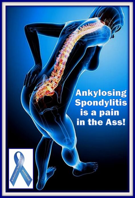 Image from spondymom Nerve Pain Remedies, Sciatic Nerve Pain Relief, Sciatica Symptoms, Spine Pain, Hip Problems, Sciatica Pain Relief, Sciatica Relief, Nerve Pain Relief, Sciatic Nerve Pain