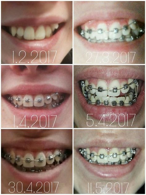 Only 3 month progress in 6 pictures! Braces Aesthetic Pictures, Braces Colours, Teeth Tips, Dental Pictures, Face Transformation, Cute Braces Colors, Braces Tips, Cute Braces, Brace Face