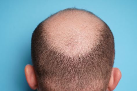 Why do people go bald?/usadailydose Fact Of Life, Female Pattern Baldness, Androgenetic Alopecia, 95 Percent, Going Bald, Male Pattern Baldness, Pattern Baldness, Perfect Skin Care Routine, Bald Women