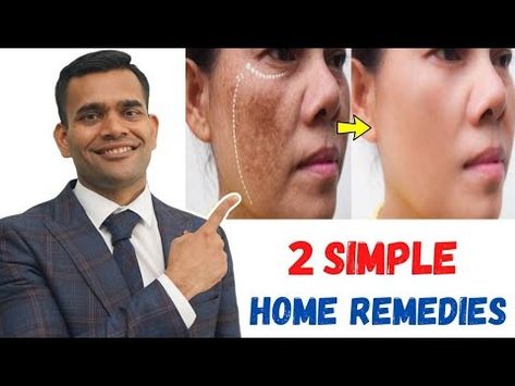 15 Days Challenge Remove Dark Spots Acne Scars Pimples marks And Pigmentation - YouTube Face Pimples Remedies, Dark Marks On Face, 15 Days Challenge, Pimple Scar Removal, Pimples On Scalp, Dark Spot Remover For Face, How To Clear Pimples, Men Skin Care Routine, Pimple Scars