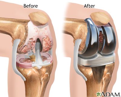 Aftercare Knee Replacement Surgery Recovery, Knee Replacement Exercises, Knee Replacement Recovery, Knee Surgery Recovery, Whole Body Vibration, Knee Replacement Surgery, Orthopedic Surgery, Knee Exercises, Knee Pain Relief