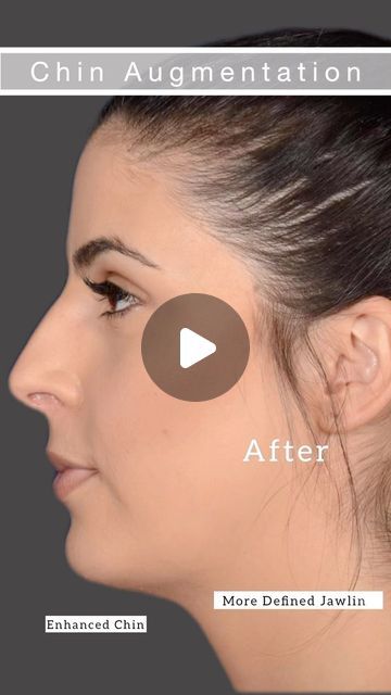 Dr. Rady Rahban | Beverly Hills: Board Certified Plastic Surgeon on Instagram: "Natural, elegant chin enhancement for overall facial balance and harmony. Share your thoughts and questions below 👇" Balance And Harmony, Plastic Surgeon, Beverly Hills, Facial, Overalls, On Instagram, Instagram, Nature