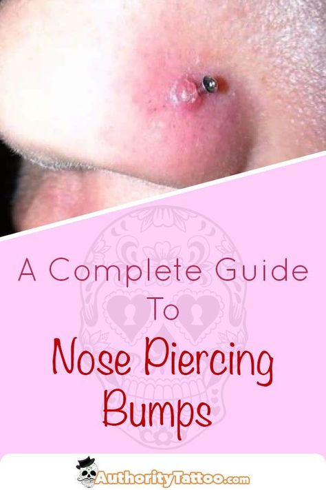 Nose piercing bumps are very common but also extremely unsightly. We delve into the mysteries of a nose bump, and advise on their causes & best treatments. Nose Ring Bump, Nose Piercing Infection, Nose Bump, Nose Piercing Placement, Nose Piercing Tips, Nose Piercing Bump, Nose Peircing, Piercing Bump, Double Nose Piercing