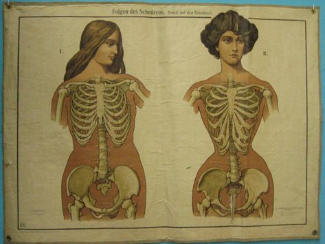 Yikes!  No wonder they had fainting couches.  And, no wonder why I can't cinch my corset in. I grew up swimming and expanding my ribs!   The effects of corsetry, vintage medical illustration.  There was no need of "removing ribs" when a corset was worn from childhood. Mode Editorials, Yennefer Of Vengerberg, Vintage Medical, Medical Illustration, Interesting History, Medical History, Art Plastique, Fashion History, Vintage Ads