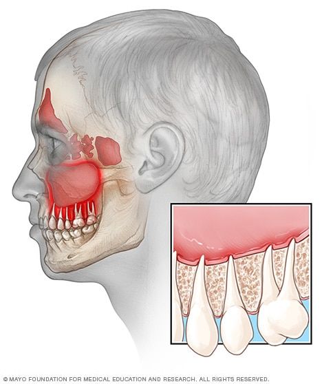 Sinusitis and tooth pain - Mayo Clinic Acute Sinusitis, Sinus Drainage, Tooth Infection, Sinus Pain, Clinic Logo, Sinus Pressure, Fat Burning Diet, Tooth Pain, Sinus Infection