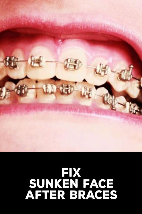 After getting your braces off, you may notice that your face has become sunken. This could be due to changes in tooth alignment and jaw positioning. The good news is that there are ways to fix a sunken face after braces. Read on for tips.