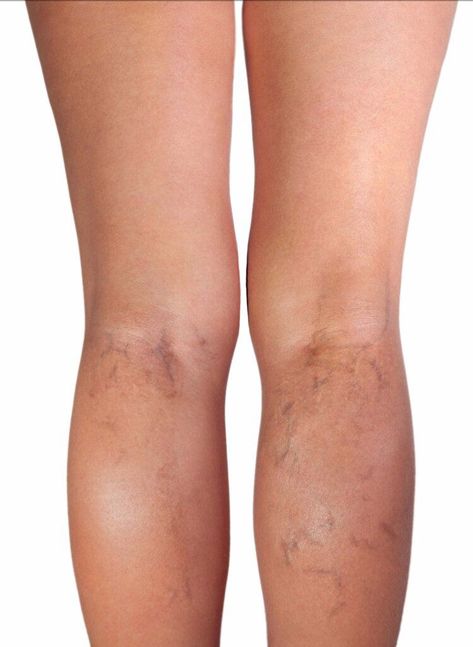 Vericous Veins, Home Remedies For Spiders, Varicose Veins Causes, Vein Health, Varicose Vein Removal, Varicose Vein Remedy, Leg Veins, Vein Removal, Arteries And Veins