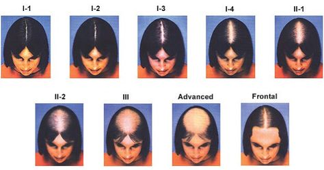 Types of balding. Androgenic Alopecia, Female Pattern Baldness, Pattern Baldness, Lost Hair, Hair Regrowth, Hair Restoration, Hair Health, Hair A, About Hair