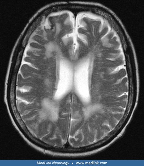 White matter abnormalities in the brain | MedLink Neurology White Matter In Brain, Theo Aesthetic, Mri Brain, Radiology Imaging, Medicine Studies, Frontal Lobe, White Matter, Medical School Studying, Human Anatomy And Physiology