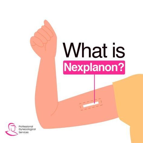 Nexplanon is a hormone-releasing birth control implant used by women to prevent pregnancy for up to 3 years. Nexplanon is a soft, flexible rod about the size of a matchstick that is inserted under the skin of a woman’s upper arm. It is a progestin-only method of birth control and does not contain any estrogen. Nexplanon is a long term contraception method and is over 99% effective at preventing pregnancy. 👉If you have any concerns. Call Us: (718) 875-4848. Contraceptive Implant, Birth Control Implant, Contraception Methods, Womens Health Care, Under The Skin, Days Like This, Care Facility, Birth Control, Cute Doodles