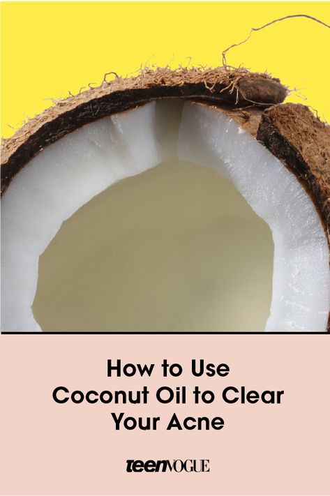 Clearing acne with coconut oil might not make a ton of sense logically, but it's actually a pretty effective tool. Here's how to use it to clear up zits. Clearing Acne, Clear Your Skin, Coconut Oil For Acne, Best Acne Products, Home Remedies For Acne, Cystic Acne, Things Under A Microscope, Healthy Bones, Clear Acne