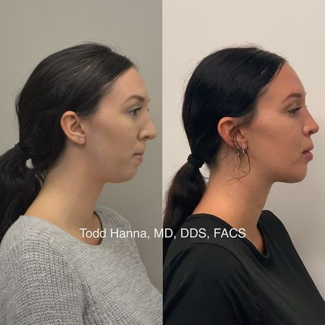 Dr. Todd Hanna, MD, DDS, FACS on Instagram: “This is a complex case with 2 main problems.. 1. She was treated with a chin implant elsewhere when she really needed orthognathic surgery…” Chin Implant Before And After Women, Orthognathic Surgery Before And After, Chin Implant Before And After, Double Chin Surgery, Chin Surgery, Kpop Plastic Surgery, Jaw Reduction Surgery, V Line Surgery, Orthognathic Surgery