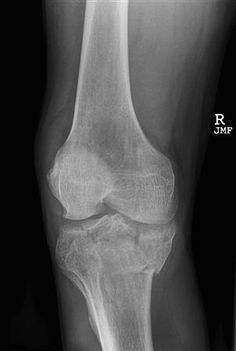 Calcaneus Fracture, Tibial Plateau Fracture, Avulsion Fracture, Meniscal Tear, Cruciate Ligament, Orthopedic Surgery, Knee Injury, Knee Pain, Case Study