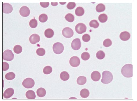 Hereditary Spherocytosis, Mls, Red