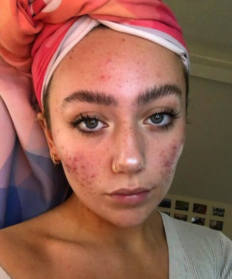 Girl With Acne, Acne Makeup, Beatiful People, Get Rid Of Acne, Rid Of Acne, Natural Acne, Healthy Skin Tips, Facial Skin Care Routine, Bare Beauty