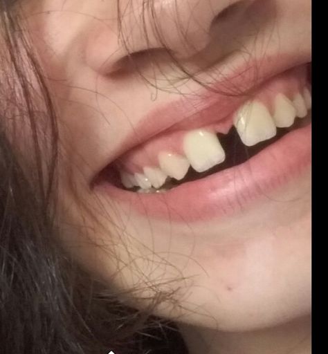 Tooth Gaps Aesthetic, Uneven Teeth Aesthetic, Missing Tooth Aesthetic, Gap Tooth Aesthetic, Tooth Gap Smile, Tooth Gap Aesthetic, Gap Teeth Aesthetic, Teeth Gaps Aesthetic, Gaps In Teeth