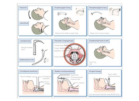 Airway Management And Sedation   Airway management in the Emergency Department is more challenging than in the operating room as patients... Cath Lab Nursing, Science Anatomy, Glasgow Coma Scale, Chronic Lung Disease, Airway Management, Respiratory Therapy, Nursing School Studying, Study Techniques, Levels Of Consciousness