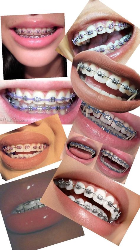 Maroon Braces Teeth, How To Get Braces, Braces Aesthetic Colors, Powerchain Braces Color, Lavender Braces, Braces Navy Blue, Brackets Aesthetic, Light Blue Braces, Braces Aesthetic