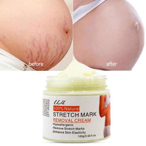 Stretch Mark Prevention, Stretch Mark Removal Cream, Armpit Whitening, Herbal Hair Growth, Natural Face Skin Care, Stretch Mark Cream, Good Skin Tips, Perfect Skin Care Routine, Stretch Mark