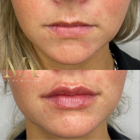 Lip Injections On Small Lips, Lip Filler For Small Lips, Small Lip Injections, Lip Fillers Before And After 1ml Small Lips, Lip Fillers Before And After 1ml Russian, Lip Filler On Small Lips, Lip Fillers Before And After 1ml, 0.5 Ml Lip Filler Before And After, Natural Lip Fillers