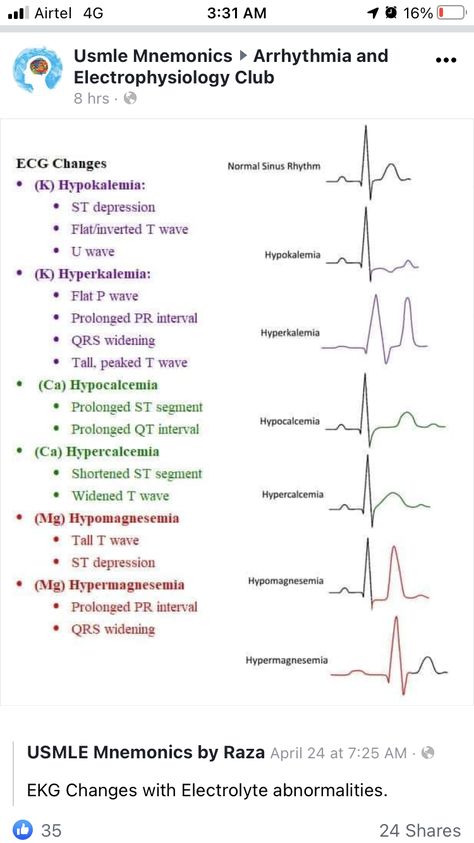 Normal Sinus Rhythm, Pr Interval, P Wave, Nursing School, Nursing, Medicine, Essence