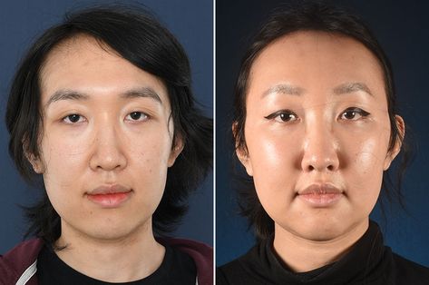 Kai before and after her Facial Feminization Surgery / FFS Browbone Reduction, Ffs Surgery, Lip Lift, Permanent Hair Removal, Reduction Surgery, Brow Lift, Video Testimonials, Hair Removal Permanent, Nose Bridge