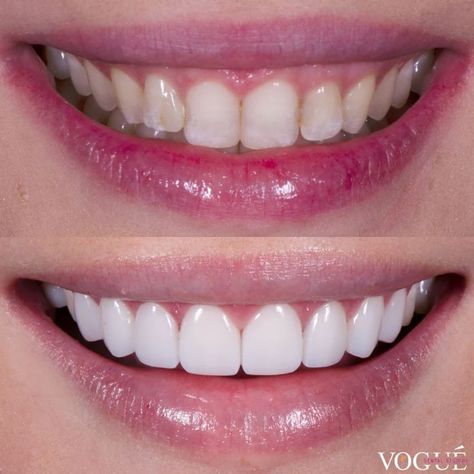 Teeth whitening tips and tricks Teeth Veneers Before And After, Teeth Before And After, Porcelain Veneers Before And After, Teeth Whitening Before And After, Veneers Teeth Styles, Teeth Fangs Natural, Invisalign Before And After, Veneers Before And After, Bright Teeth