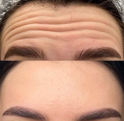 Botox works wonders 😍🔥 What a beautiful result 😍 Tired of having wrinkles and fine lines? No worries 😉  Just DM me or call for a Botox appointment ❤️ It won’t bother you anymore 💯 📲 (917) 701-0253  📞 (585)441-3838 #botoxnewyork #botoxinjections #botoxinjectionsnyc #botoxfacial #botoxtreatment #botoxtreatmentnyc #botox Botox Photography, Botox Aesthetic Photography, Botox Images, Botox Aesthetic Instagram, Botox Astetic, Armonizacion Facial, Botox Results, Botox Facial, Vitamin C Skincare