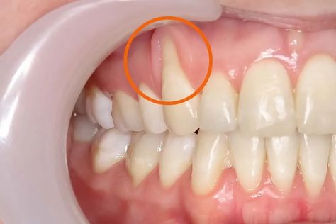 Reverse Receding Gums. In addition to gum disease, household… | by Isacsunsettid | Medium How To Reverse Receding Gums, How To Heal Receding Gums, How To Strengthen Gums, Regrow Gums Natural Remedies, How To Repair Receding Gums, Gum Diseases Chart, Inflamed Gums Remedies, Receding Gums Remedies, Reverse Receding Gums