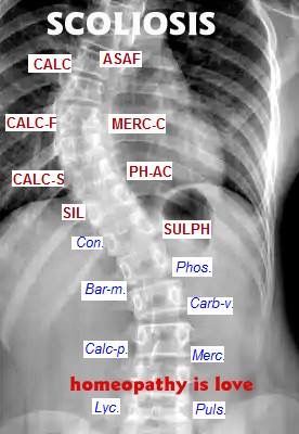 Homeopathy for Scoliosis Homoeopathy Clinical Tips, Bone Healing Foods, Exercises For Lower Back, Cell Salts, Acne Medicine, Homeopathy Remedies, Herbal Medicine Recipes, Flower Remedies, Bach Flower Remedies