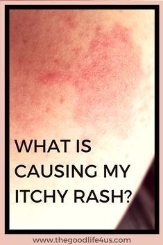 Skin Rash Remedies, Itchy Skin Rash, Body Rash, Rashes Remedies, Itchy Rash, Allergy Remedies, Skin Remedies, Itchy Skin, Skin Issues