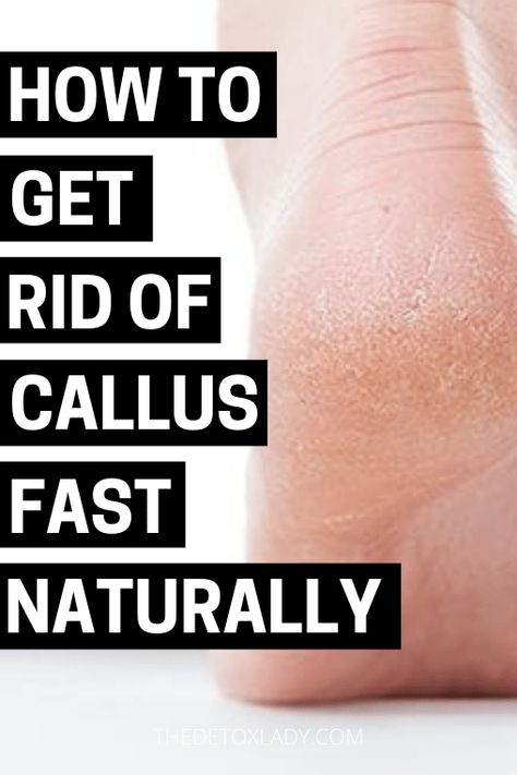 Diy Callous Remover That Works Like Magic - The Detox Lady Callous Remover Diy, Callus Remover Diy, Feet Care Calluses, Callous Remover, Diy Foot Soak, Nail Remedies, Natural Cleaning Solutions, Nail Problems, Callus Remover