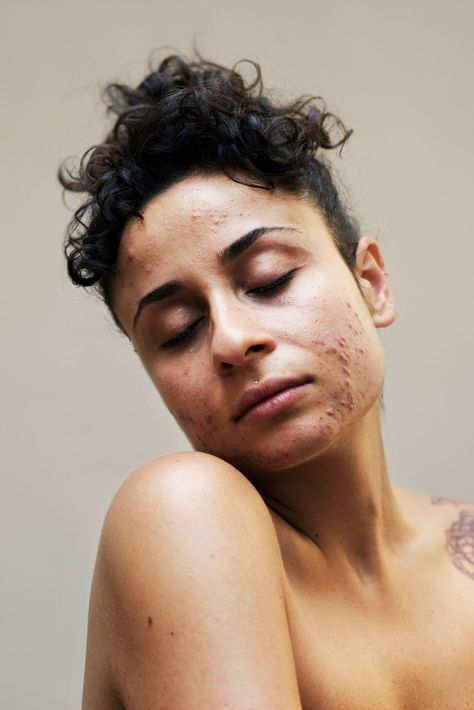 the #freethepimple movement wants you to embrace the skin you're in - i-D Body Positivity Photography, Human Photography, Body Photography, Be Confident, Beauty Standards, Real Beauty, 인물 사진, New Skin, Body Image