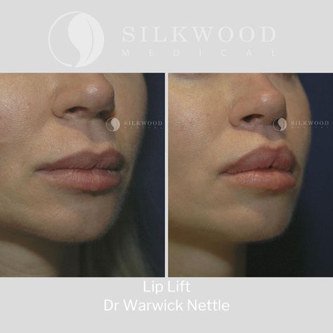 Lip Flip With Filler, Lip Lift Surgery, Lip Surgery, Breast Lift Surgery, Lip Lift, Lips Inspiration, Face Surgery, Skin Tightening Treatments, Beauty Science