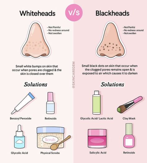 How to prevent black heads and whiteheads what are they what products to use to treat whitehead and black heads