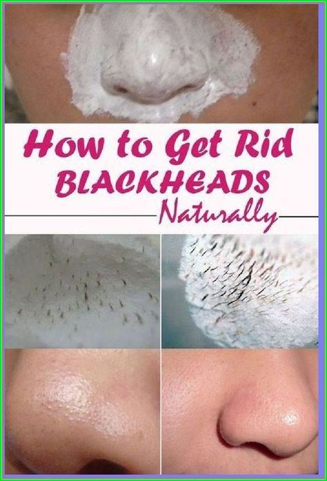 Get Rid of Blackheads For Good Summer Skincare Routine, Skincare Remedies, Rid Of Blackheads, Blackhead Mask, Natural Mask, Get Rid Of Blackheads, Summer Skincare, Summer Skin, Blackhead Remover