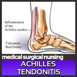 Medical-Surgical Nursing Achilles Tendinopathy, Military Workout, Achilles Tendon, Medical Surgical Nursing, Chiropractic Care, Calf Muscles, Heel Pain, Sports Medicine, Foot Pain